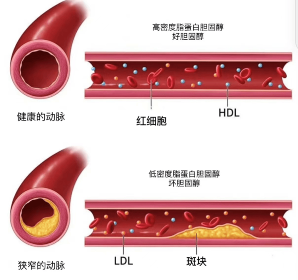 丰益国际 新研究揭示，\＂坏胆固醇\＂升高是冠心病与脑梗死高发的主要原因。